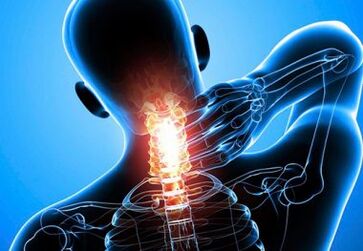 intenzivne bolečine v vratu z napredovalo osteohondrozo