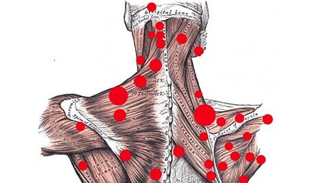Sprožilne točke v mišicah, ki povzročajo miofascialne bolečine v hrbtu