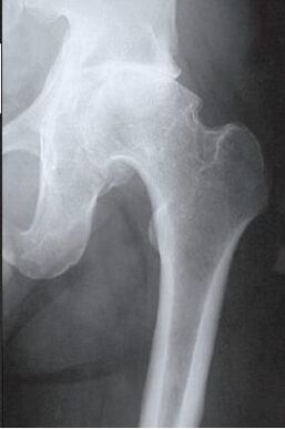 MRI pregled prizadetega kolčnega sklepa