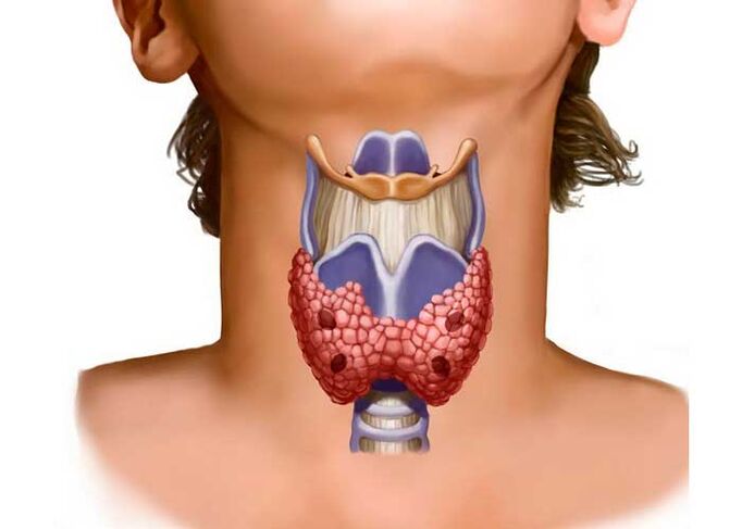 težave s ščitnico kot vzrok za bolečine v vratu