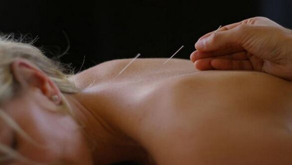 akupunktura za bolečine v hrbtu