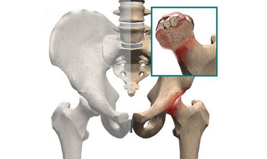 Nekroza glavice stegnenice je eden od vzrokov bolečine v kolčnem sklepu