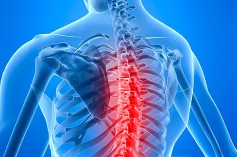 Torakalna hrbtenica z znaki osteohondroze