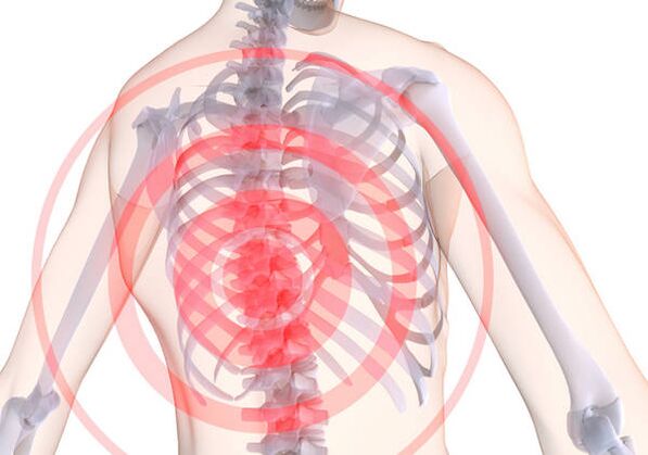 Torakalno osteohondrozo spremlja dorsago - akutna bolečina, ki omejuje mišice