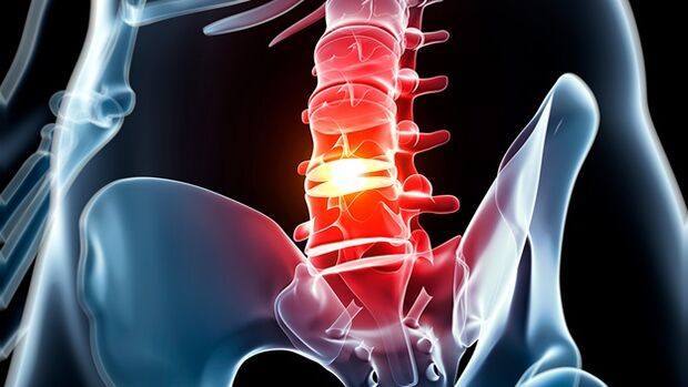Osteohondroza ledvene hrbtenice